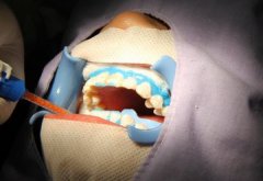 冷光美白牙齒嘅維持時間有多長