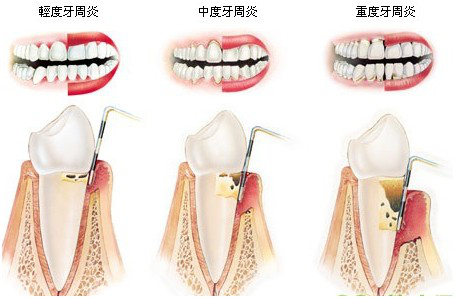 治療牙周炎嘅方法有邊D