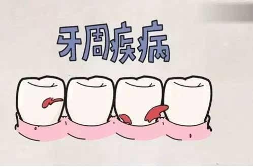 牙齦炎形成嘅原因