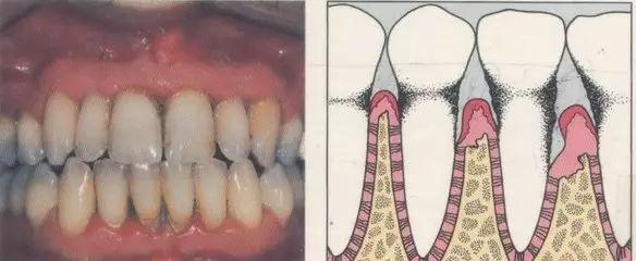 牙齦炎表現症狀