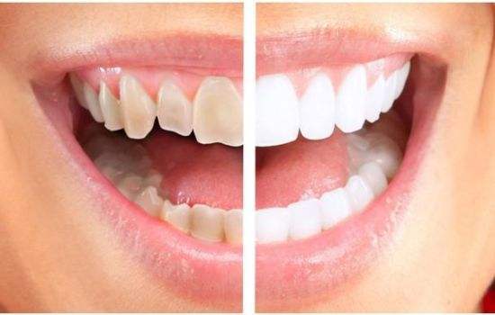 四環素牙治療