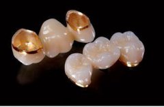 珠海钛合金烤瓷牙費用幾多？