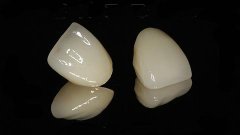 珠海牙科醫院做烤瓷牙需要幾錢一顆?