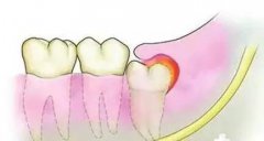 珠海拔一顆智齒大概需要幾多錢？