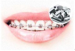 珠海箍牙收費幾多呢？