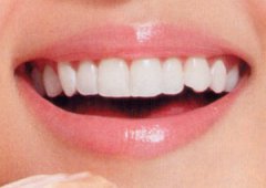 珠海鈷鉻合金義齒的費用需要幾多？