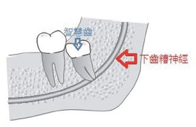 智齒到底該唔該拔