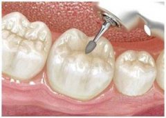 補牙點解要盡早？