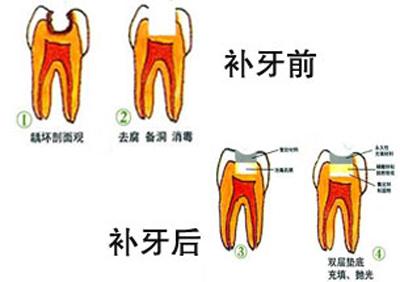 補牙前後注意事項