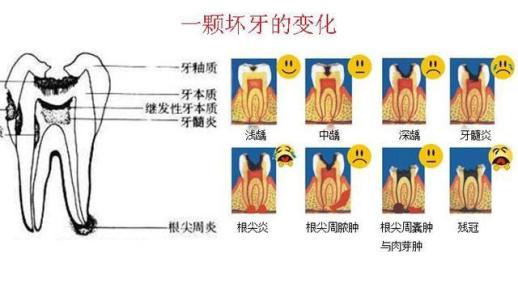 補牙和根管治療的區別