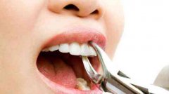 拔牙後多耐可刷牙同吃飯？