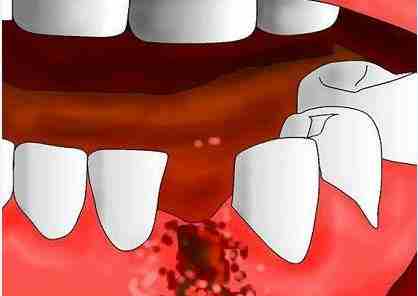 拔牙後併發症有邊D