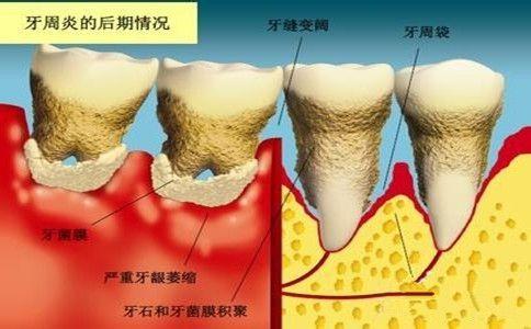 珠海牙周炎治療收費