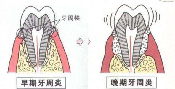 珠海牙周炎治療幾多錢