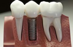 即刻種牙優點有邊D呢？