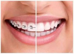 帶牙套術前術中有邊些註意的