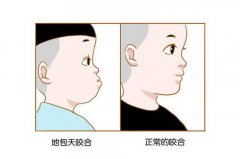 出現地包天點矯正呢？