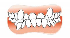 地包天會不會遺傳呢？