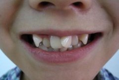 兒童牙齒不齊怎麼辦