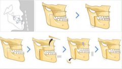矯正前應注意邊D事項？
