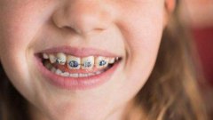 牙齒矯正痛嗎？