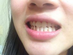 牙齒矯正期間，要註意邊D飲食問題？