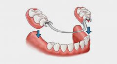 鑲牙前嘅牙根該如何處理？
