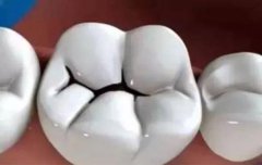 你嘅牙齒有「黑洞」嗎？專家提示：補牙要及時