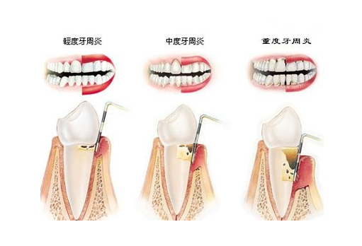 牙周炎重要性
