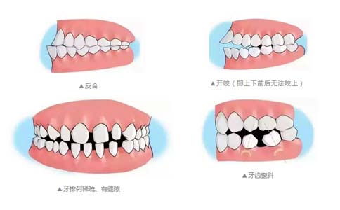 兒童誘導咬合費用