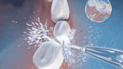 牙齒拋光並不會損傷牙齒！放心洗牙吧！