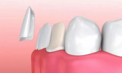 一篇文章話您知牙貼面材料有邊D?