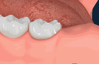 拔牙會傷害身體嗎
