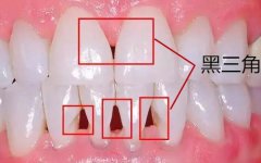牙齒「黑三角」你知幾多？