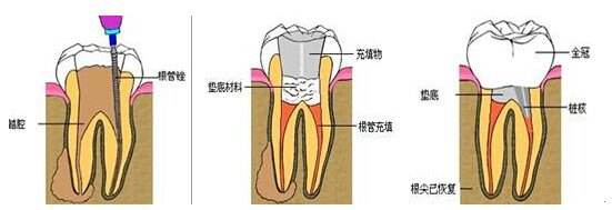 杜牙根牙套價錢