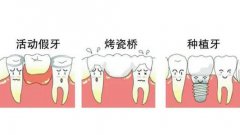 缺牙點解要鑲牙？