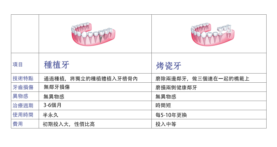 種牙同鑲牙區別