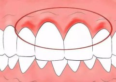 牙齦出血治療費用係點樣？