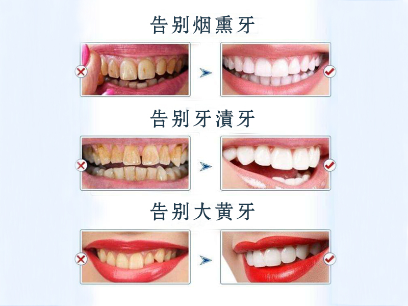 牙齒美表後注意事項