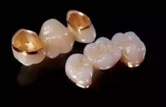 同大家分析一下珠海烤瓷牙需要多少錢？