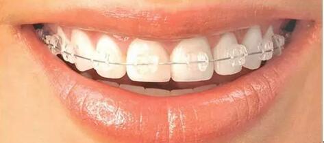 牙齒畸形治療方法