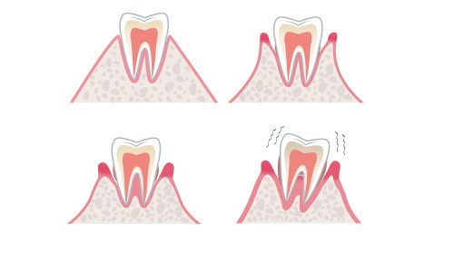 牙齒鬆動,牙齒鬆動治療方法