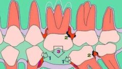 造成牙齒缺失嘅原因有邊D呢?