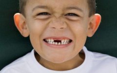 缺牙，你適合邊種修復方式？