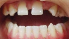 造成缺失牙的原因有邊D？