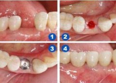 牙缺失點算，一般種一粒牙要幾錢？