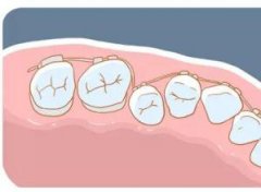 矯正牙齒的N種錯誤認知