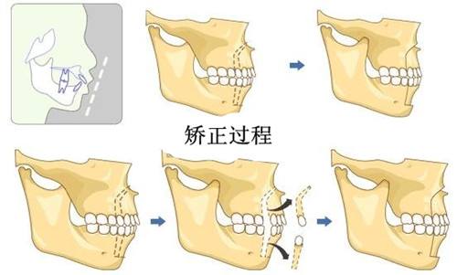 牙齒矯正價格差別大的原因