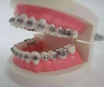 了解各大矯正方式優缺點，搵到心水方式