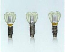 半口植牙修復過程係點樣呢？